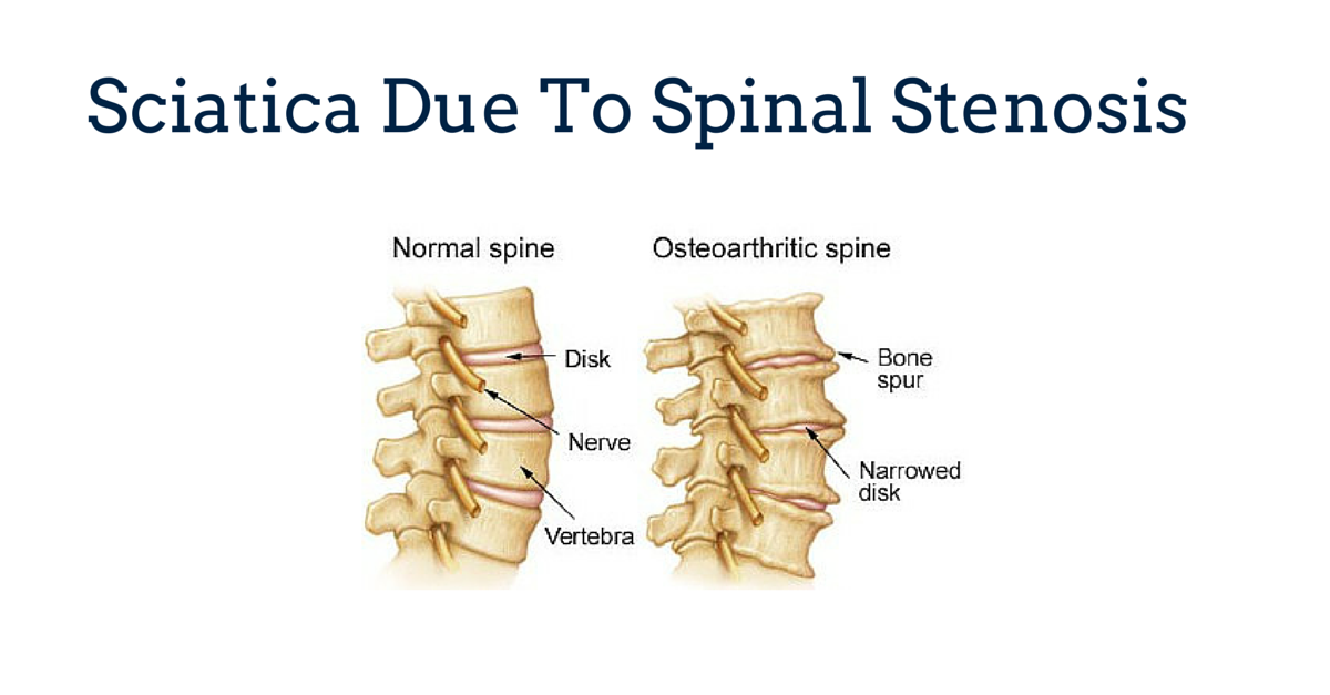 Sciatica Due To Spinal Stenosis Gray Chiropractic St Catharines Spine 