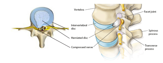 sciatica due to disc herniation