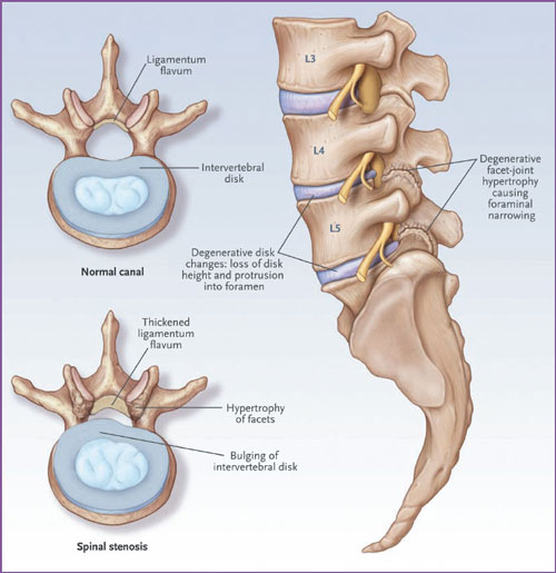 spinal stenosis