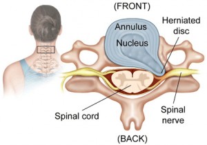 cervical-disc-herniation_web