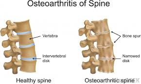 spinal arthritis